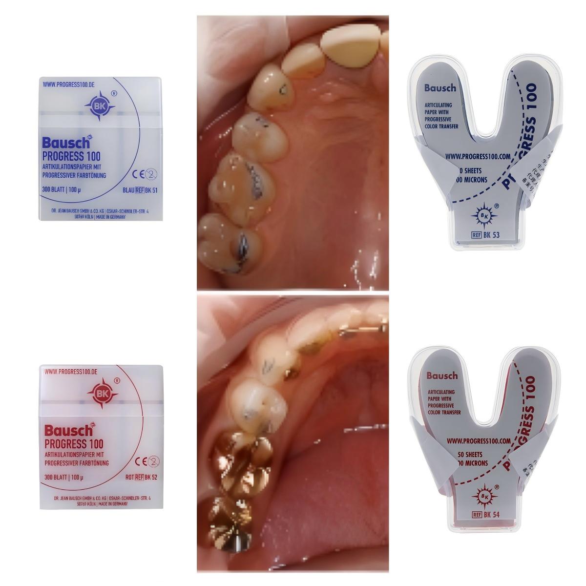 Bausch BK51 BK52 BK53 BK54 Den - Bite Indicator recensie en prijs